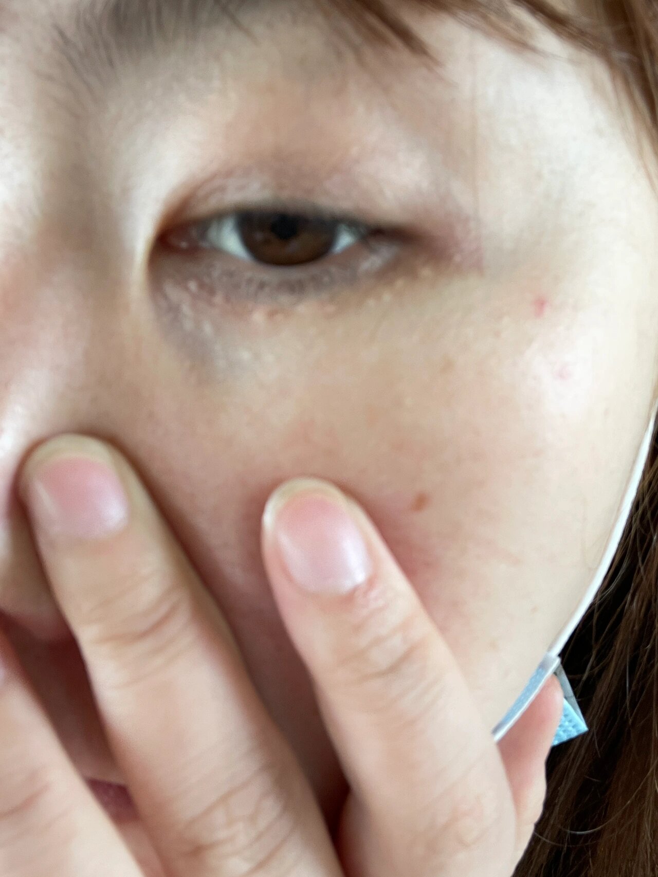 眼周围长满小颗粒 最近眼角的颗粒越长越多,也不知道这到底是什么,想