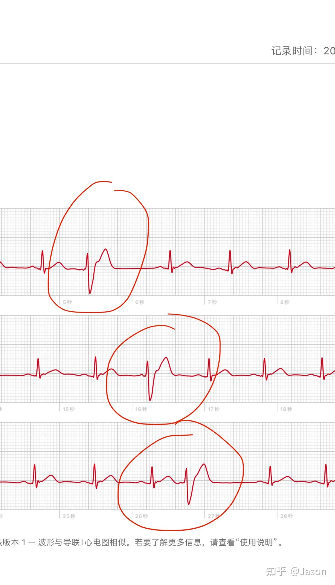 心脏早搏心电图怎么看图片