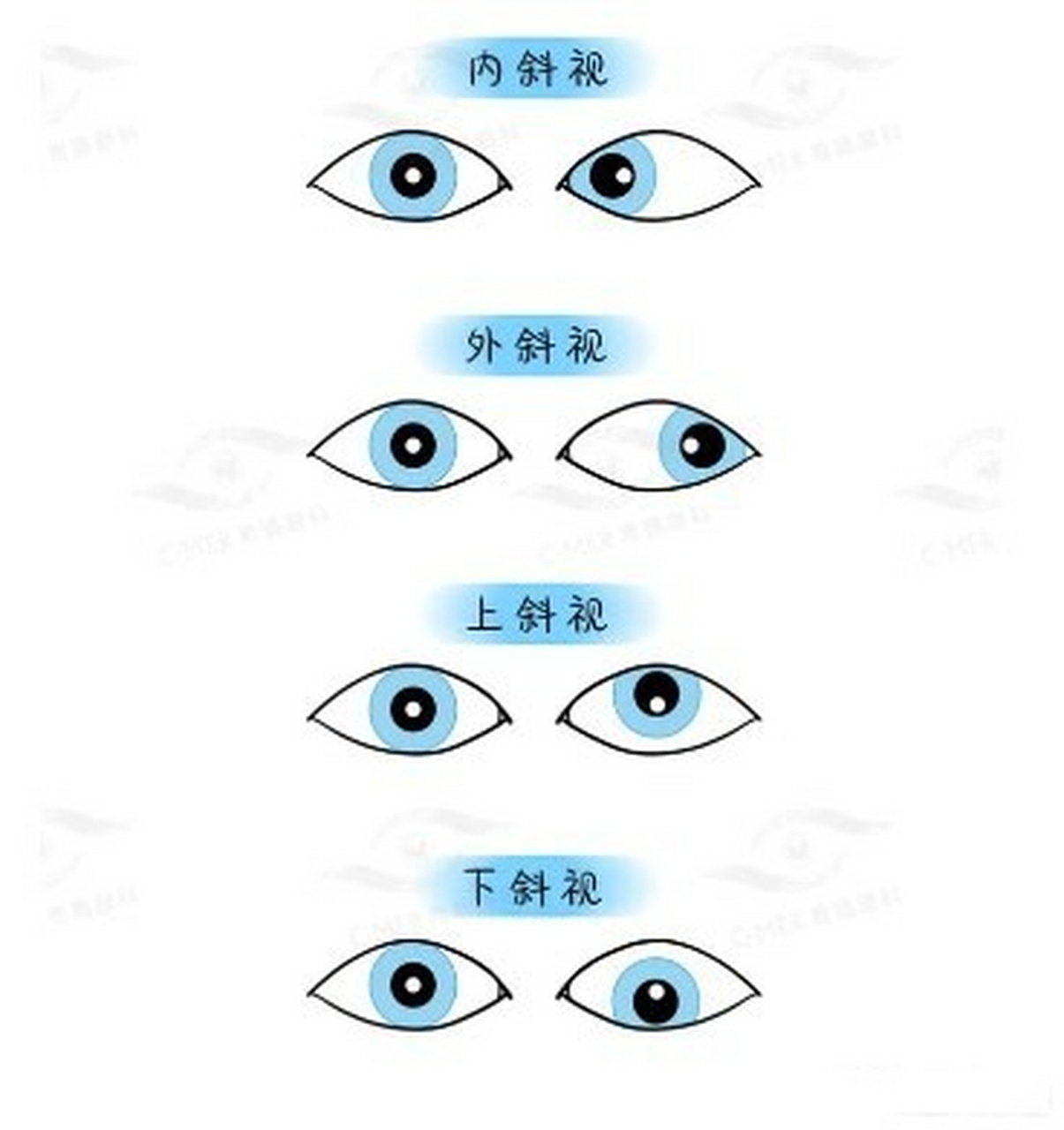 孩子有斜视,一定需要手术治疗吗?