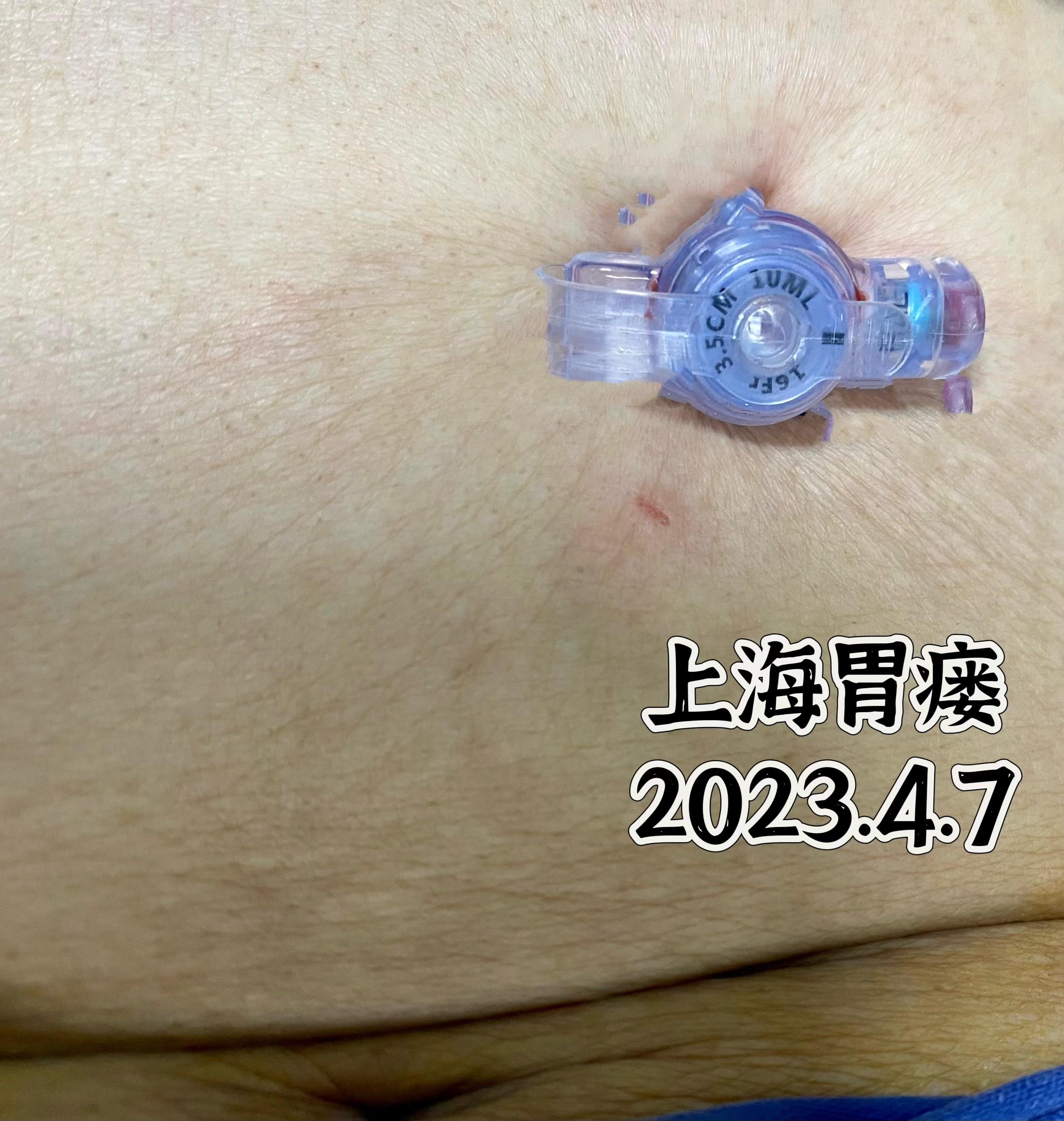 纽扣式胃造瘘手术食道只留一丝丝的缝隙已经一周多没有好好吃饭喝水了