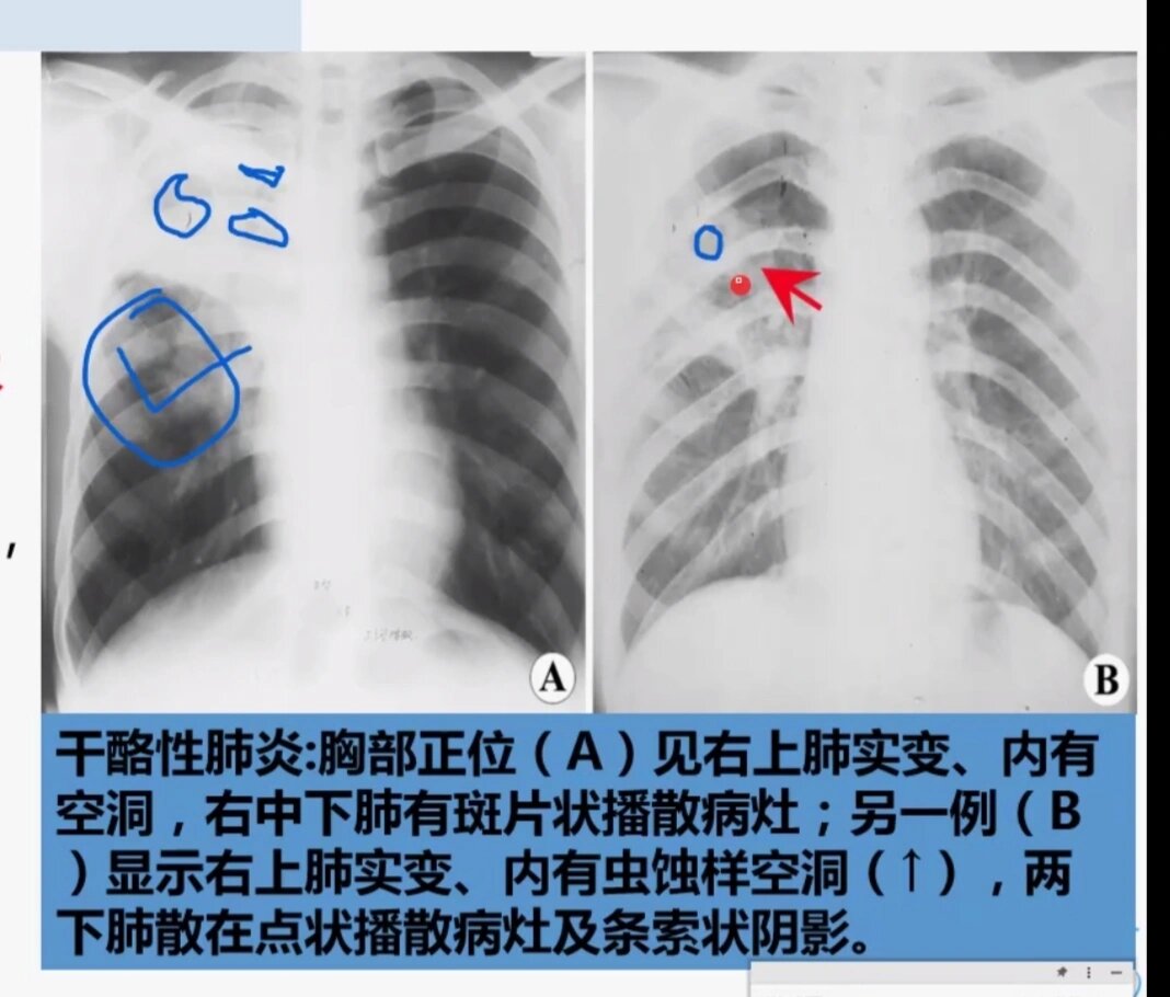 肺结核片子图片怎么看图片