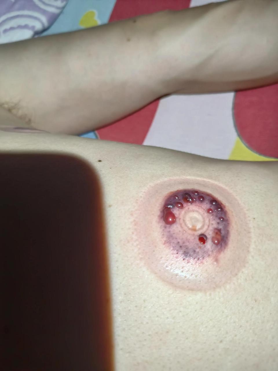 拔完罐以后怎么会成这样?这是中毒太深了吗?