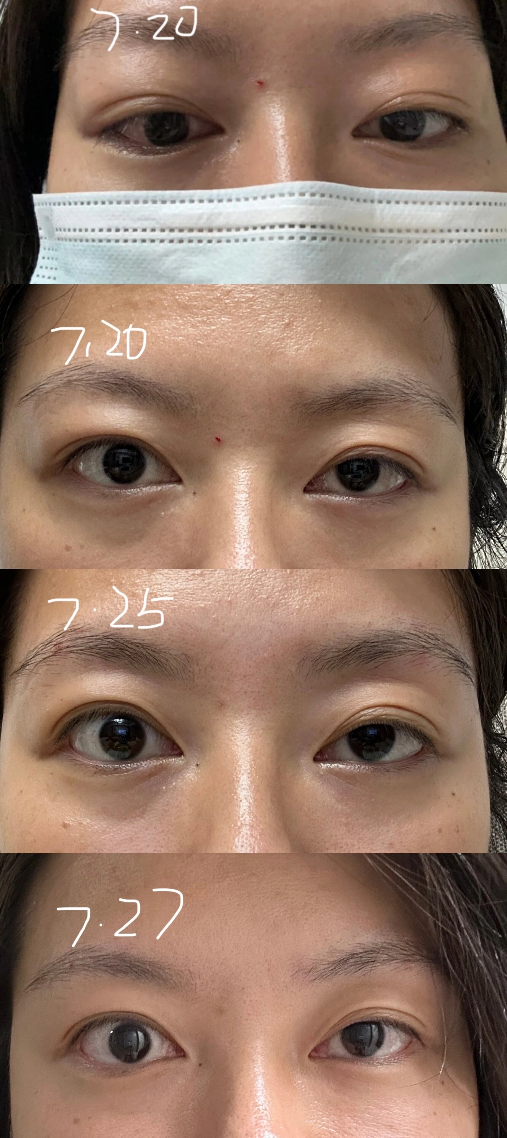 甲亢大小眼注射曲安奈德分享