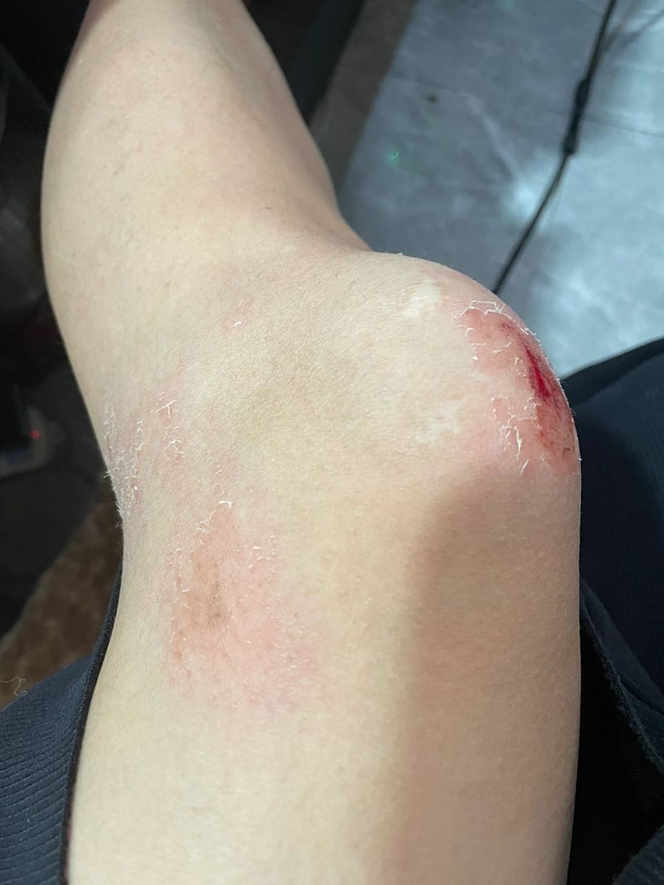 记录第一次骑电动车摔跤!