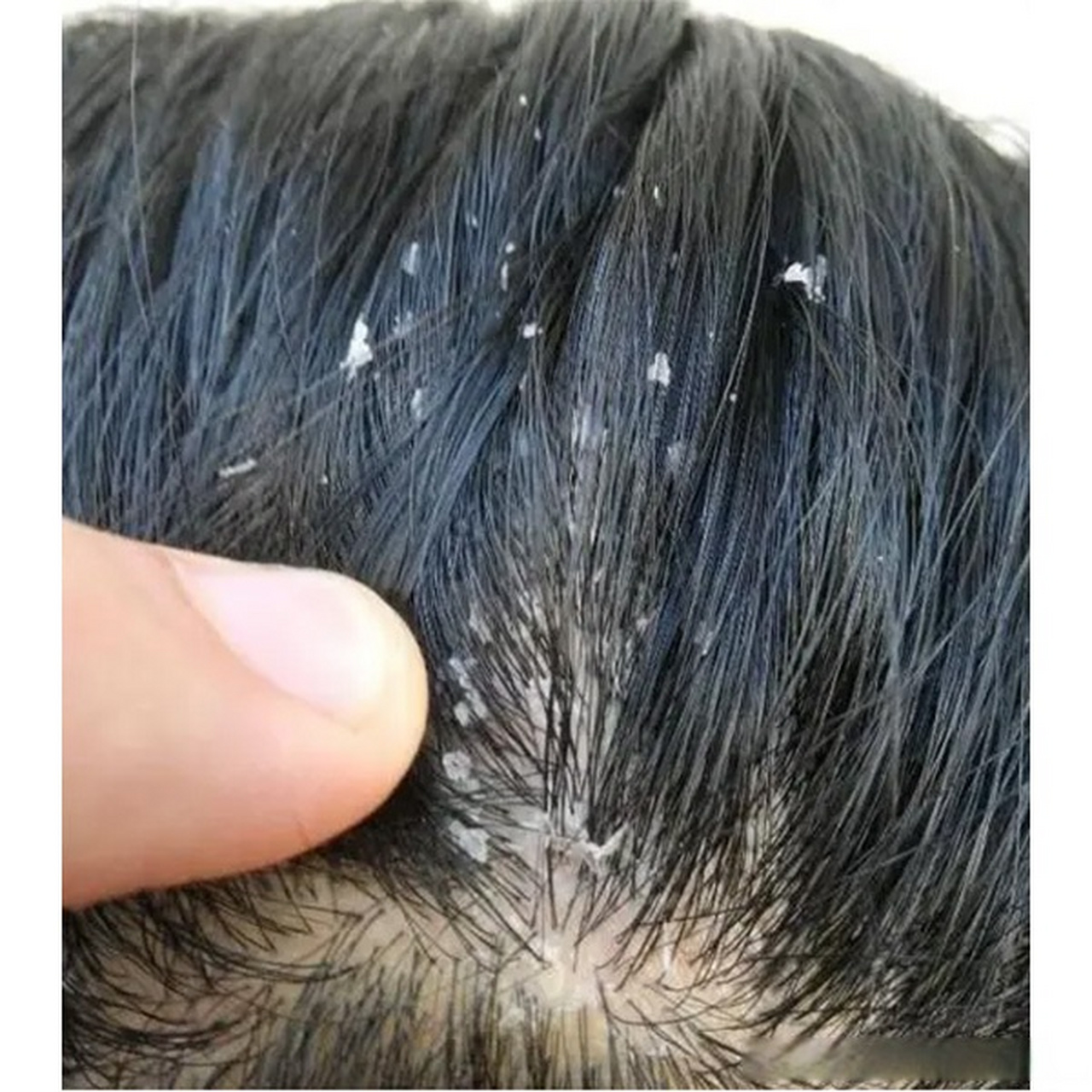 这些头皮屑不仅给他的生活带来了身体上的困扰,还影响了他的心理健康.