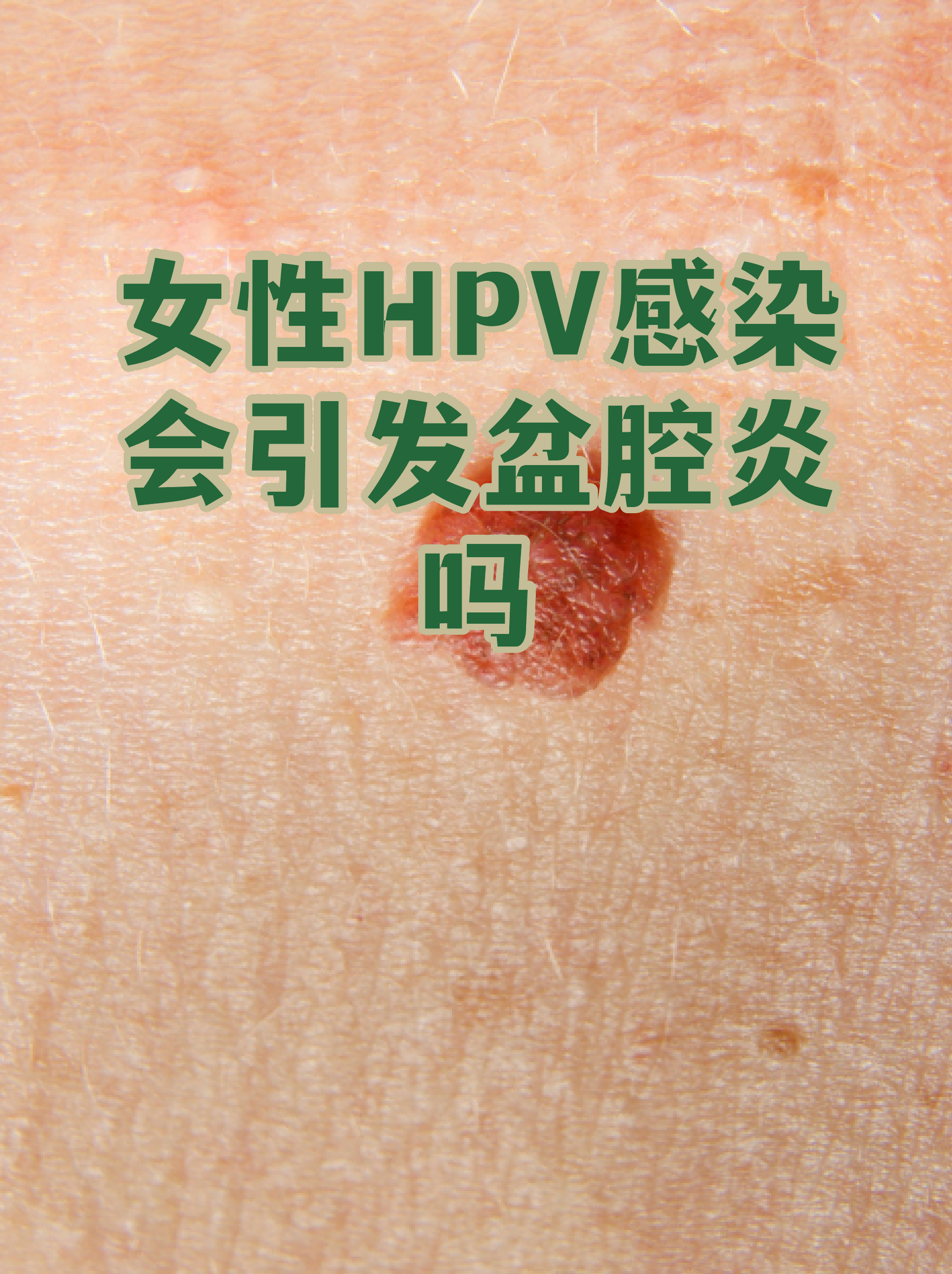  女性巨细胞病毒是什么引起的(女性巨细胞病毒是什么引起的原因)