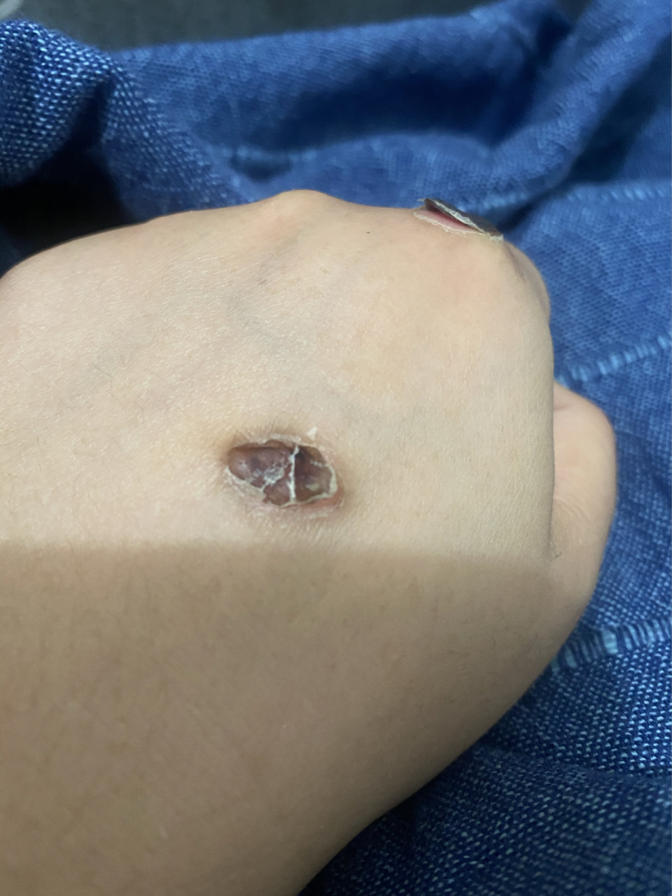 分享一则液氮冷冻痊愈过程! 一定不要沾水!不要沾水!不沾水!