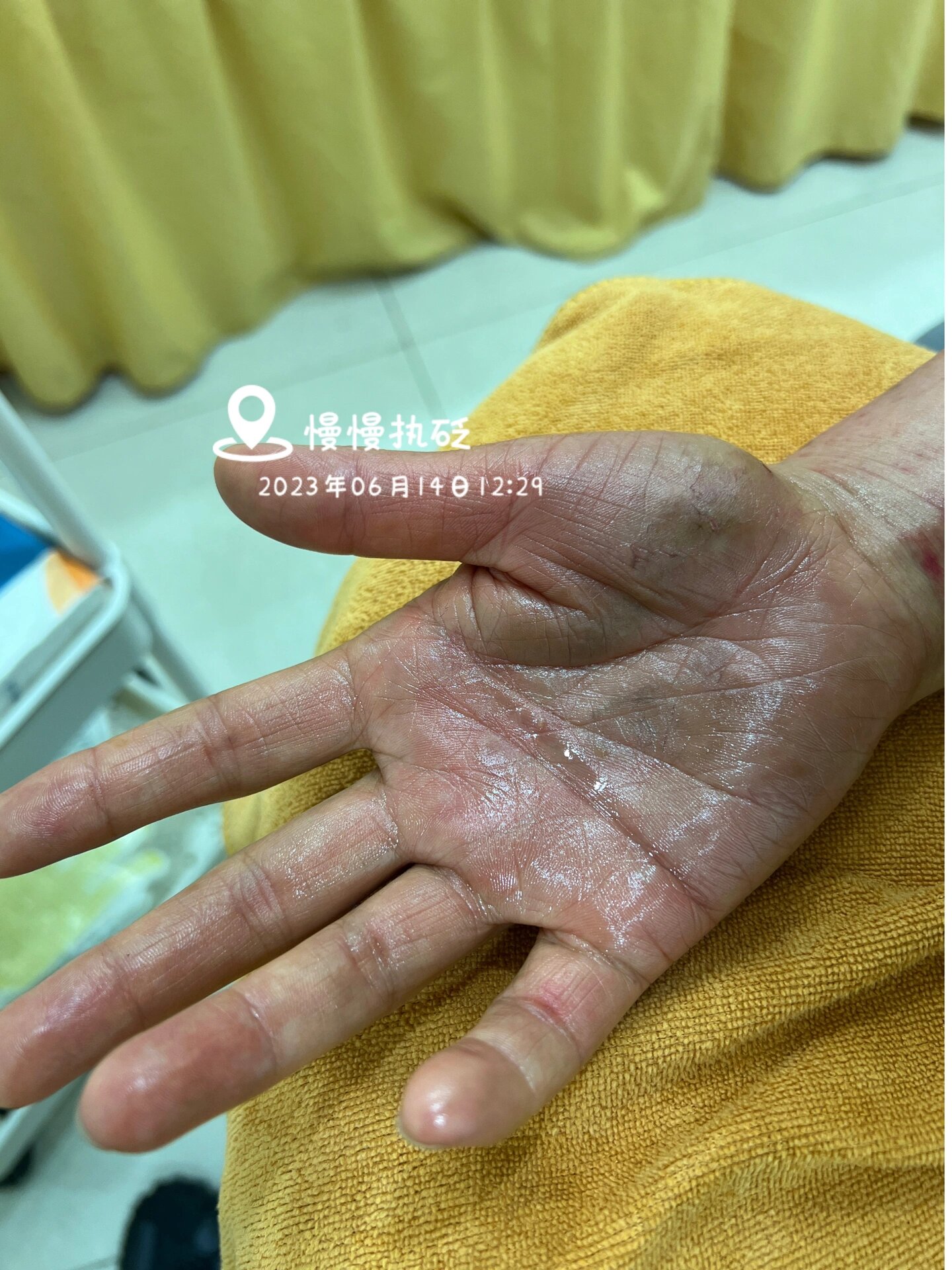 讲到的痧像有渗出皮肤的灰水黑水黄水绿水总之就是各种颜色的水