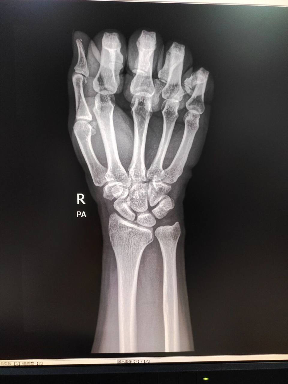 腕关节正侧位(右侧)