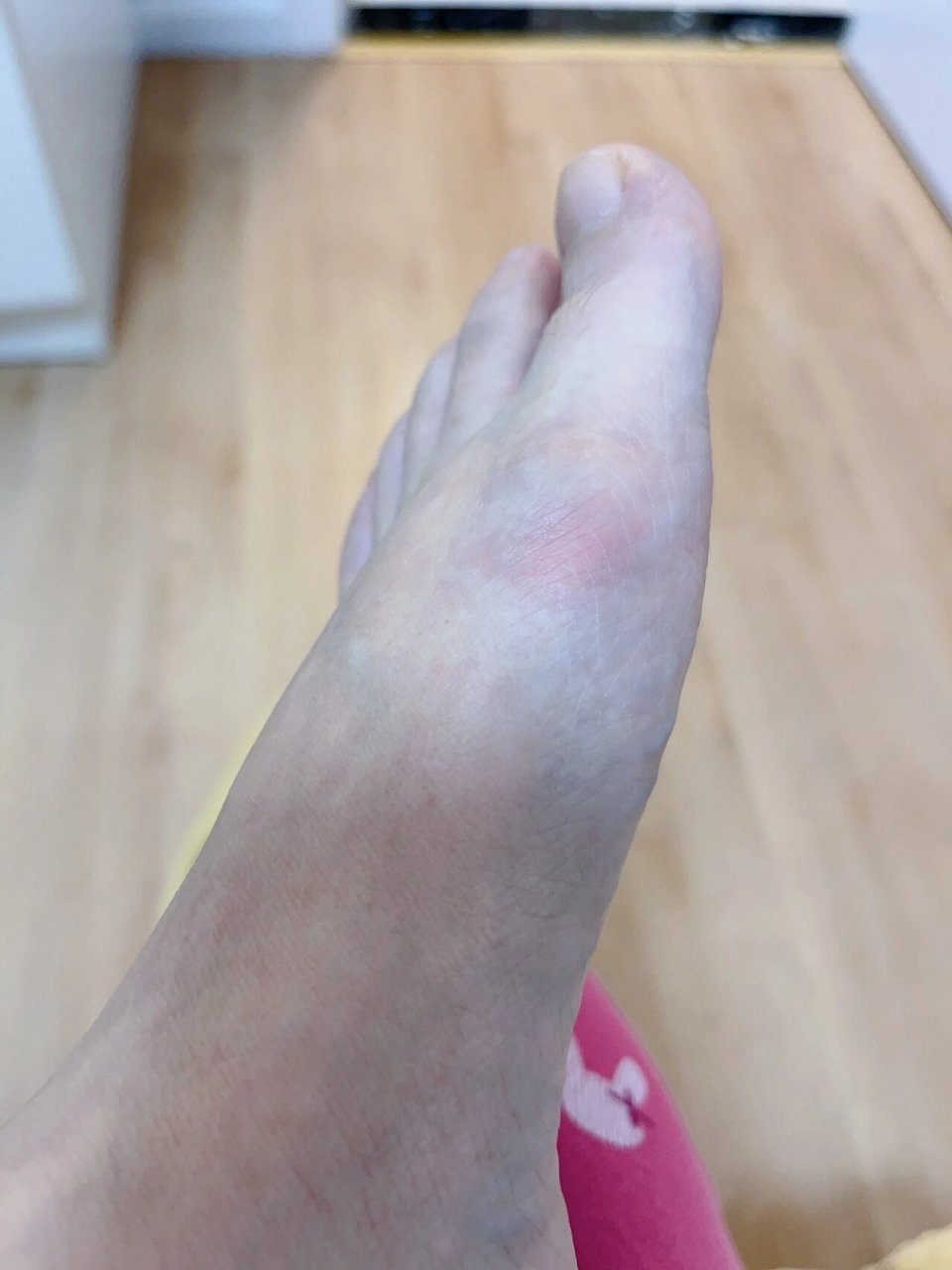 不吃药就500以上01 这几天降温了,又开始红肿疼,痛风脚一定要注意