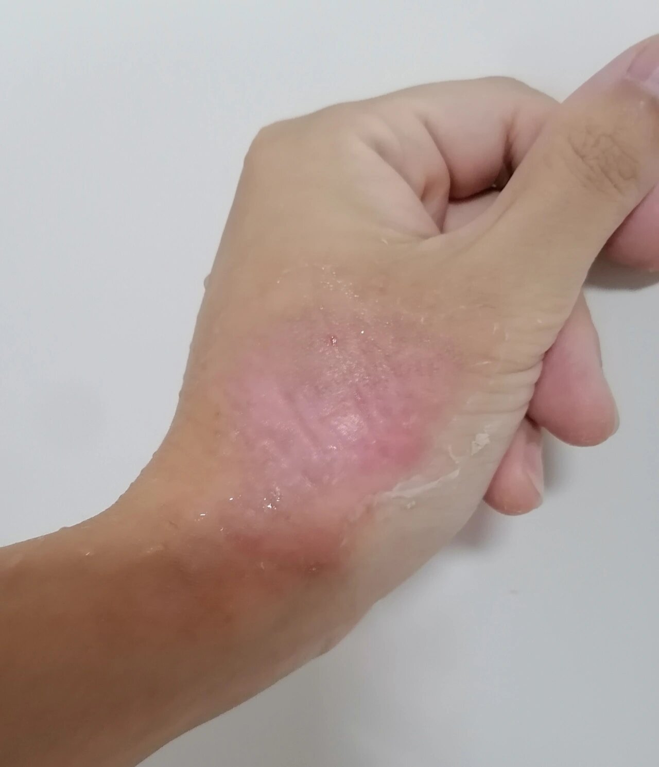 历时一个月,开水烫伤的手完全好了,我果然是专业人士,就等颜色恢复啦