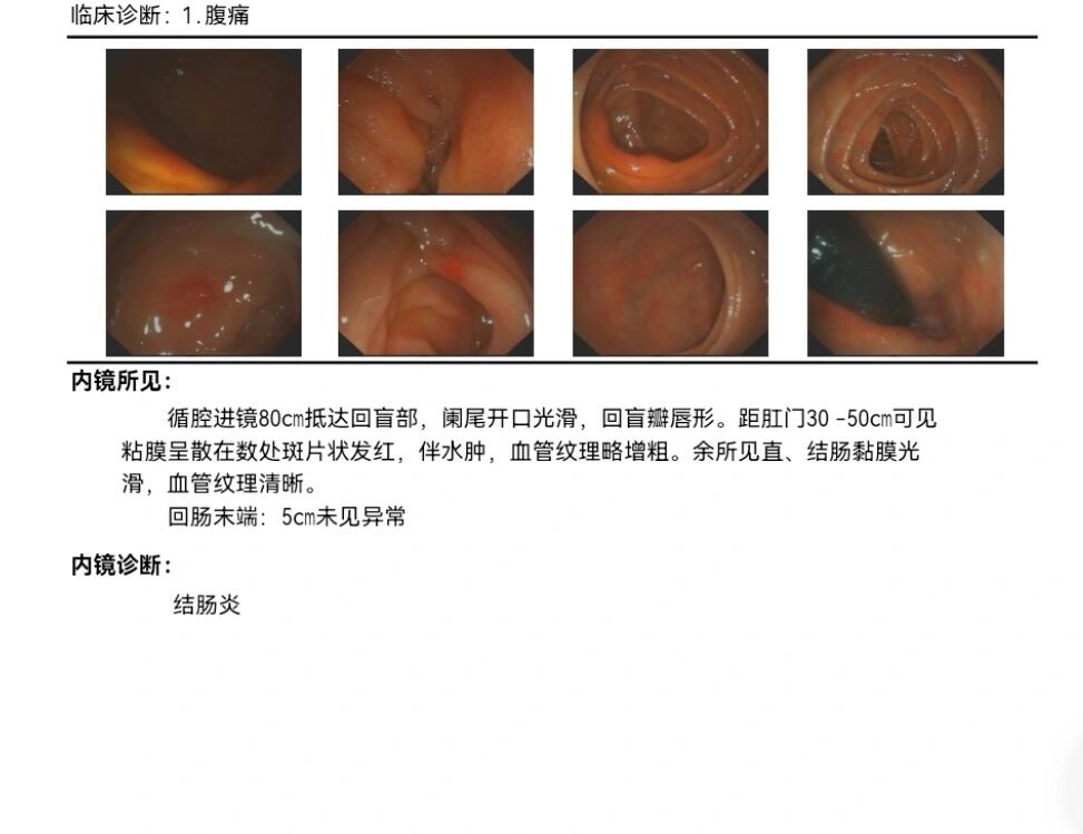 肠镜阑尾开口正常图片图片