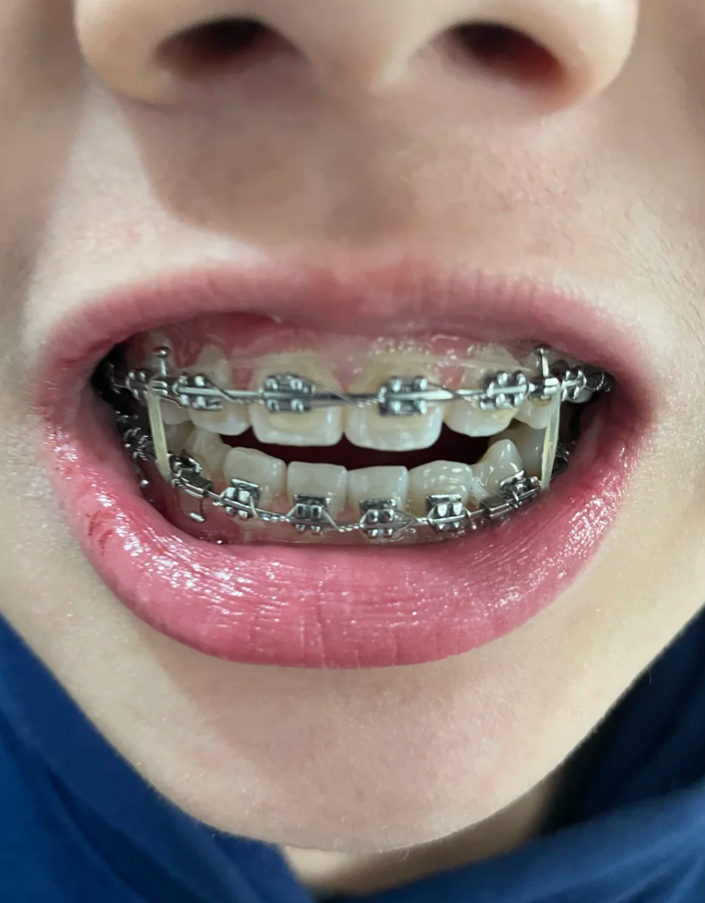 牙齿咬合咬到旁边的肉怎么回事?