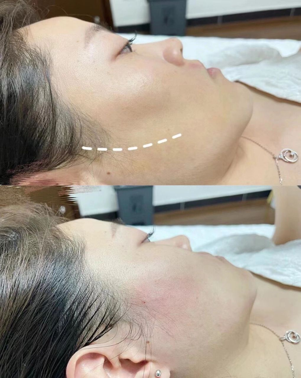 【填充面颊】 面颊凹陷俗称老人窝,非常显老 年纪轻轻被小孩子叫阿姨