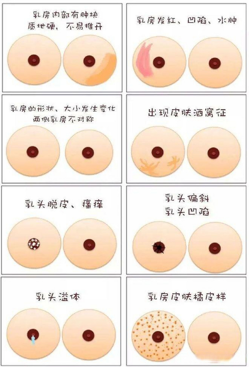 早期乳腺癌 真实图片