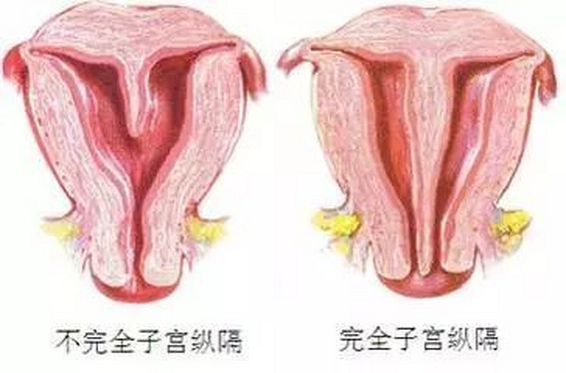 纵隔子宫又分为部分纵膈子宫和完全纵膈子宫.