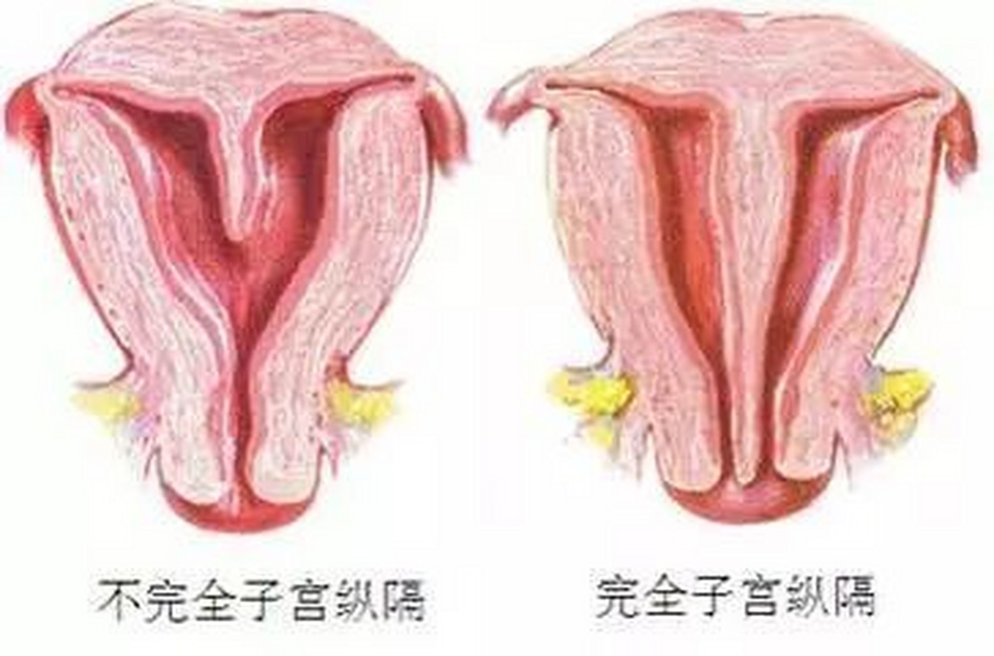 子宫纵隔纵隔子宫图片