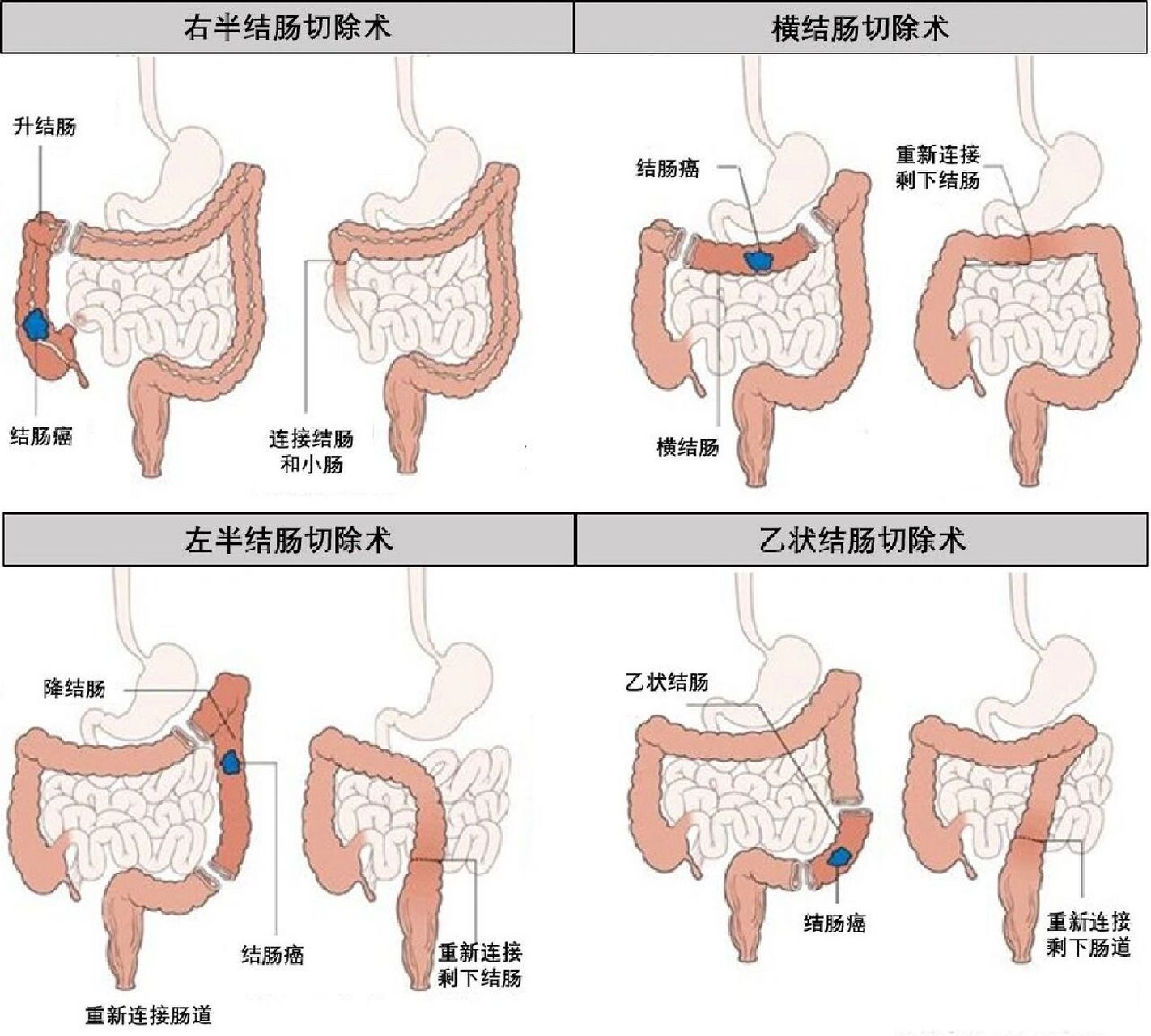 结肠癌手术过程图片图片