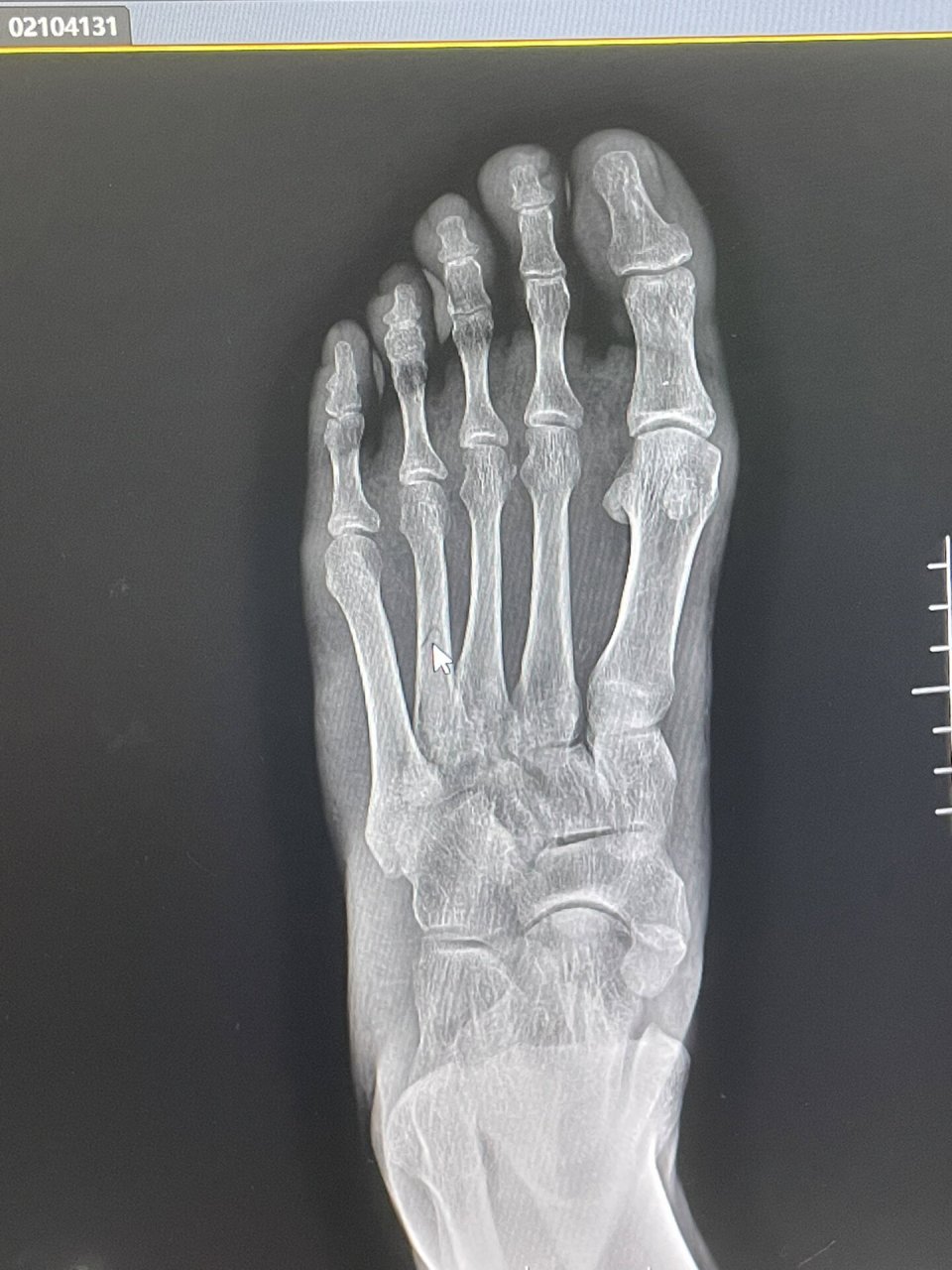 脚掌骨折康复记录之第一周 1月4日骨折,诊断结果是第二第四跖骨两处均