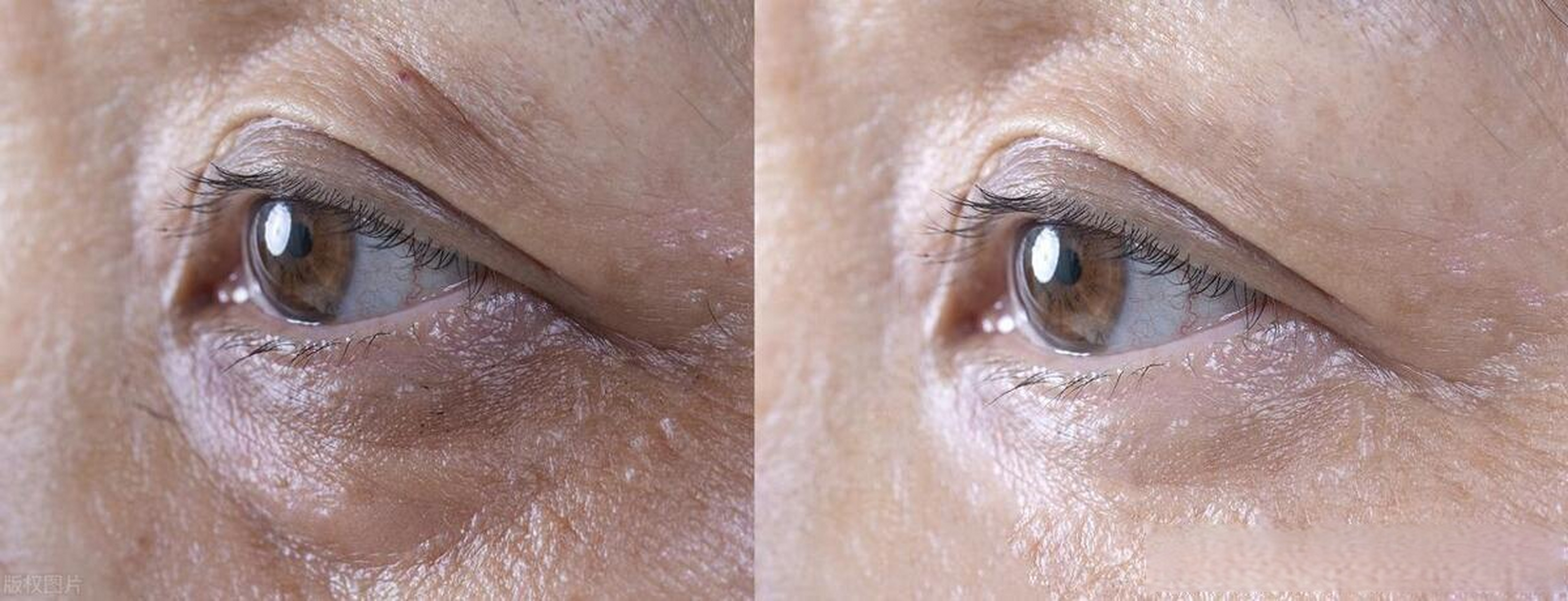 老年人眼眶发黑,不可掉以轻心 黑眼圈不只是熬夜造成的,还与年龄增长