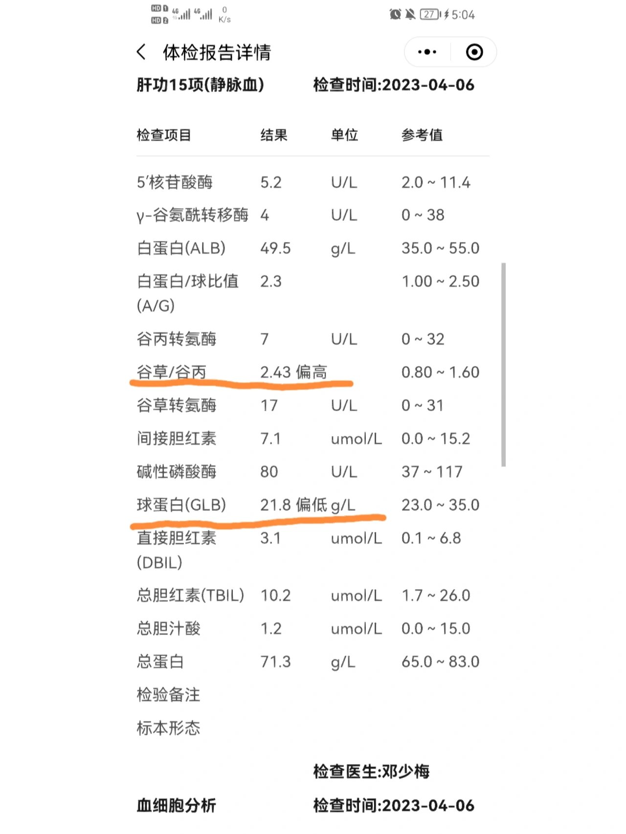 体检报告谷草谷丙偏高,球蛋白偏低 大家知道谷草谷丙偏高和球蛋白偏低