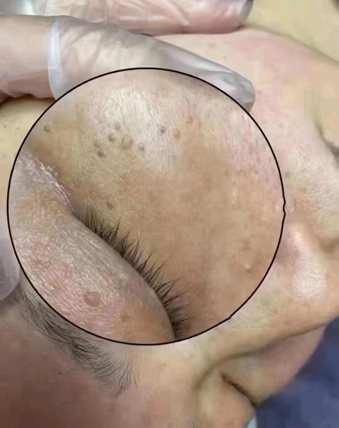 脸上的这个东西叫做疣95