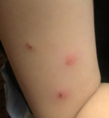 床上出现红疙瘩,很可能是蚊虫,跳蚤或螨虫叮咬引起的