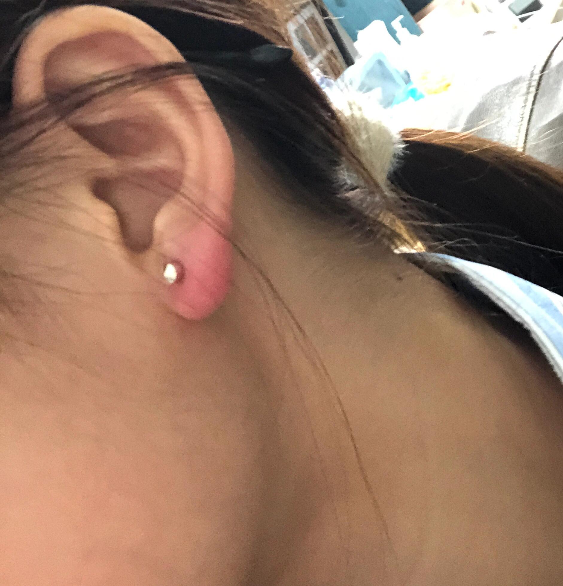 姐妹们 打完耳洞第三天了 还红肿怎么办?