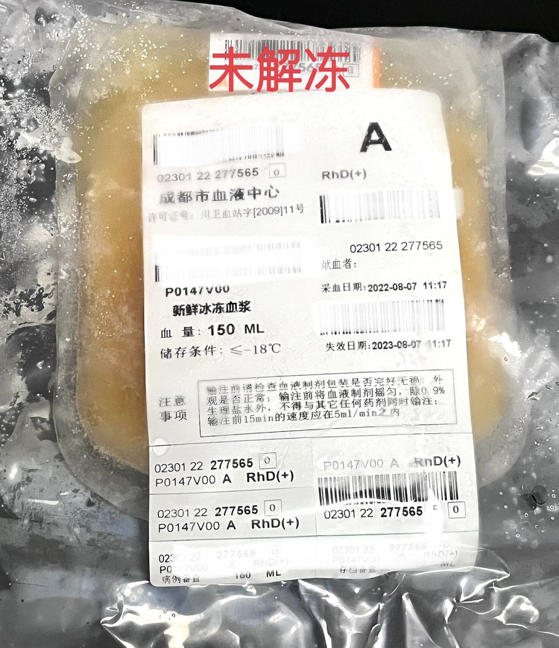 新鲜冰冻血浆 新鲜冰冻血浆(ffp):是由抗凝的新鲜全血于6小时内在4