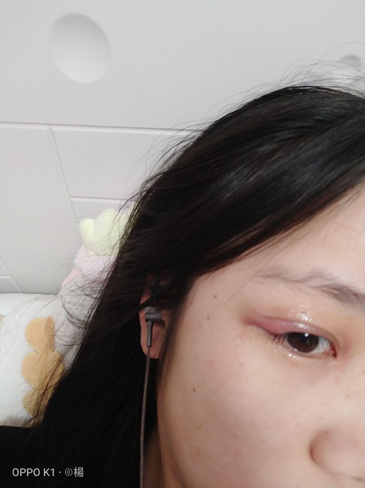 有没有得过外麦粒肿的朋友怎么个痊愈过程