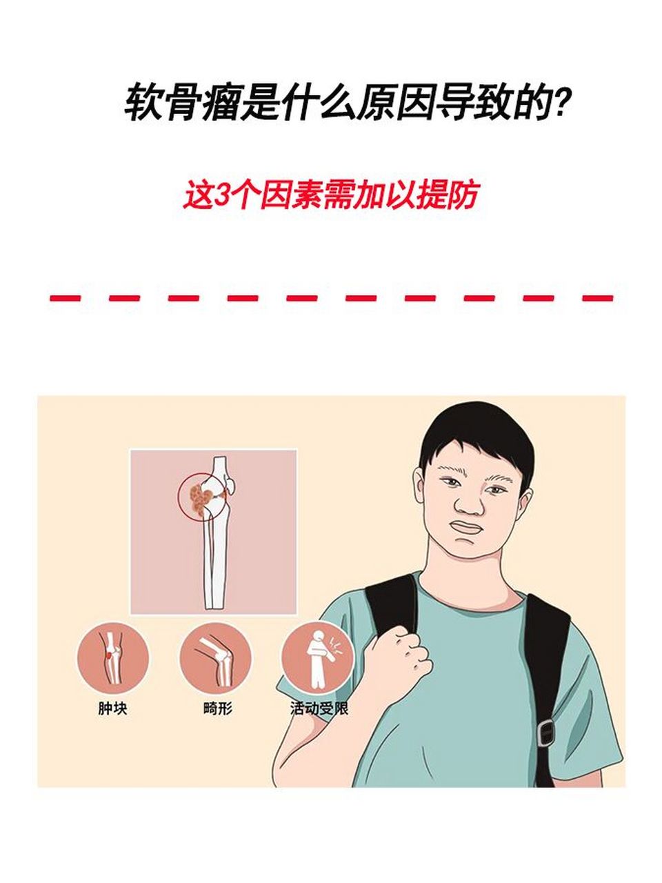 这3个因素需加以提防 软骨瘤为良性骨肿瘤,多发于髓腔内