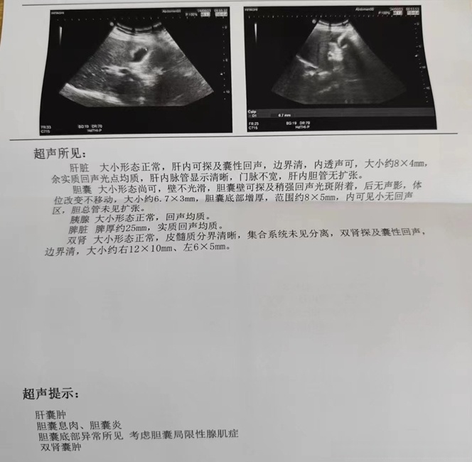 如果初次发现,没有症状的话可以先观察,定 胆囊腺肌症超声报告超声
