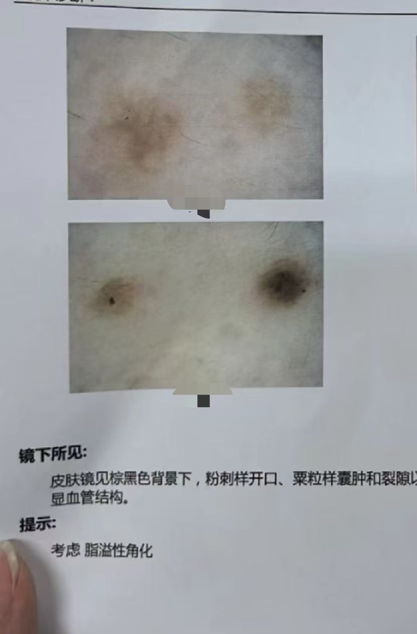 腿上长斑的原因有很多,常见的有皮肤老化,紫外线照射,外伤,色素沉着