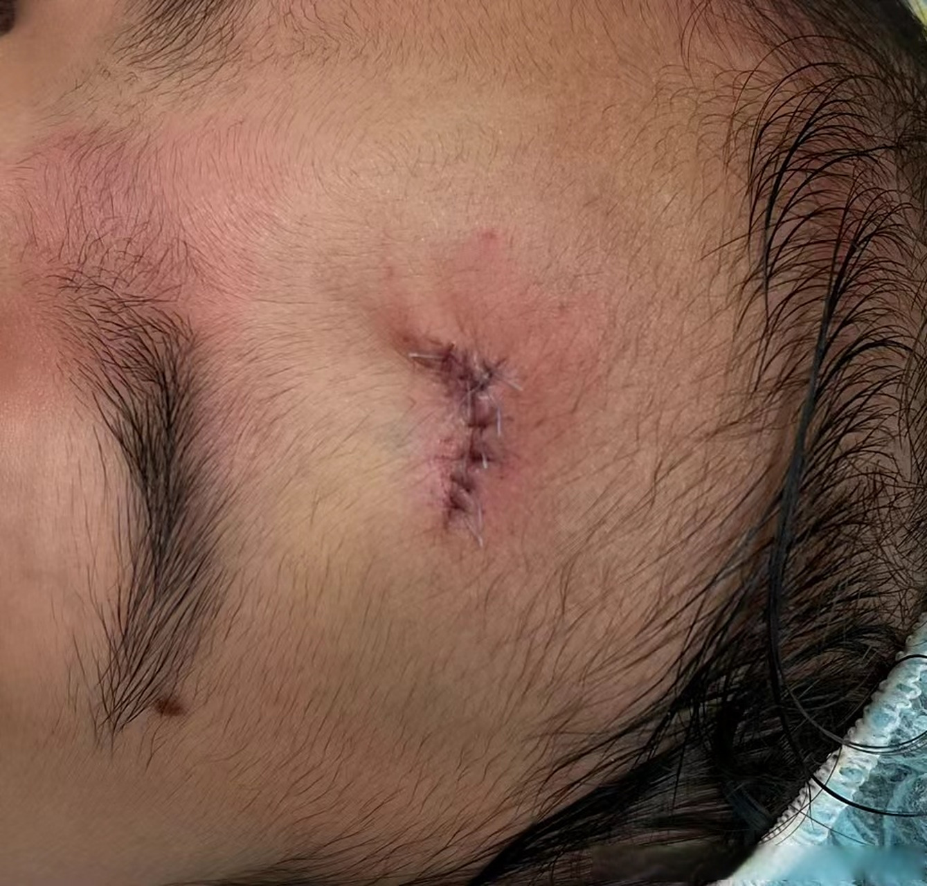 昨晚额头摔伤的小女生急诊缝合后,妈妈担心疤痕,想要美容缝合托朋友