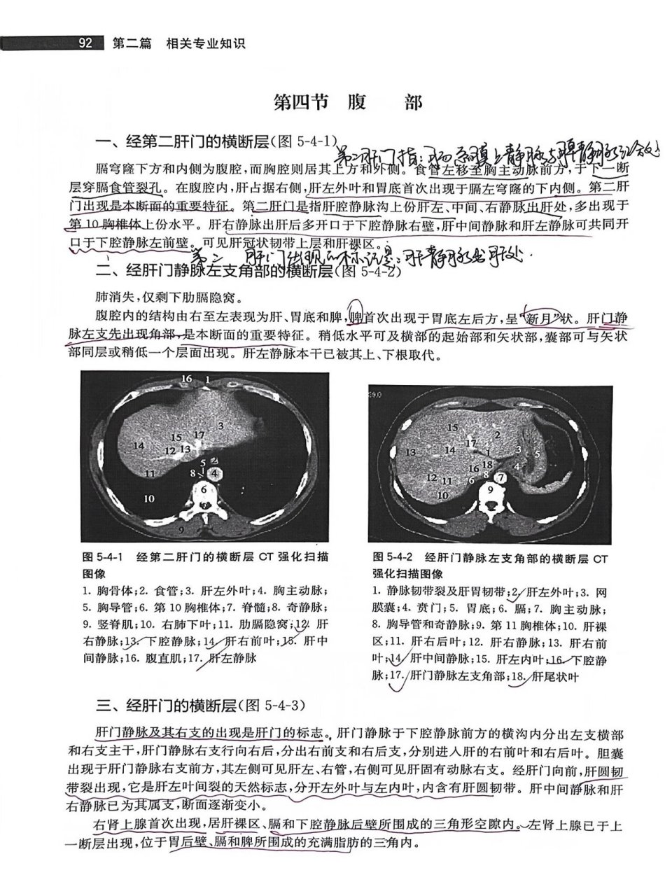 第二肝门ct图片