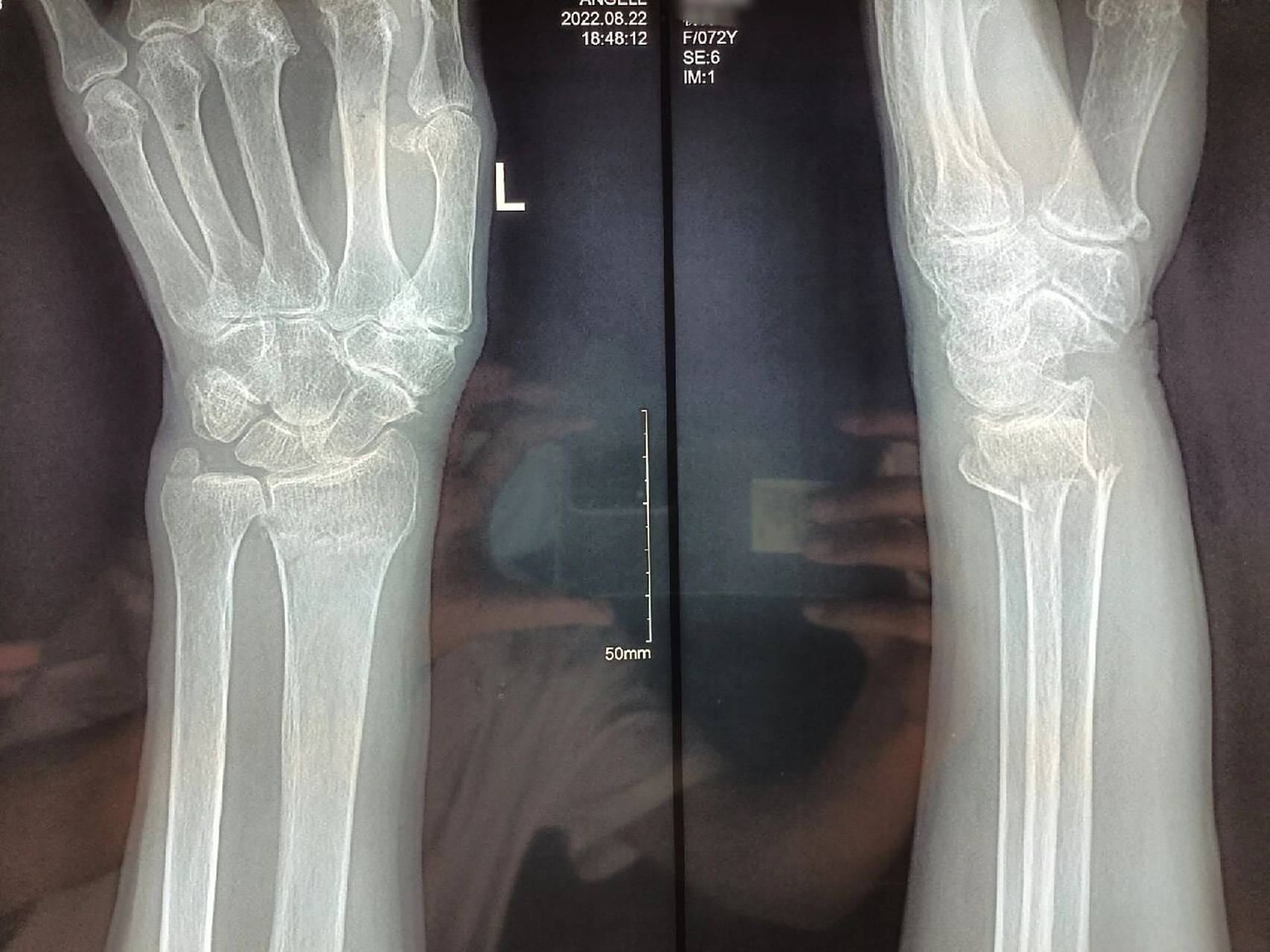 左桡骨远端骨折 患者女,72,左桡骨远端骨折,手法牵引复位高分子夹板外