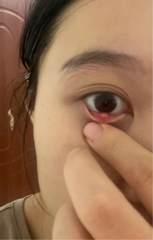 宝宝下眼睑里面长了一个白色的颗粒