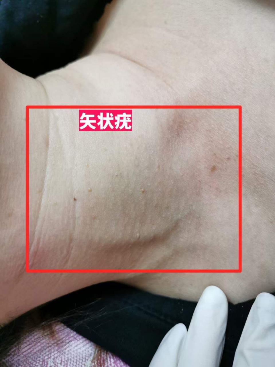 99面诊矢状疣 姐姐说生完孩子后开始长,4年时间看着它越长越多,疣是
