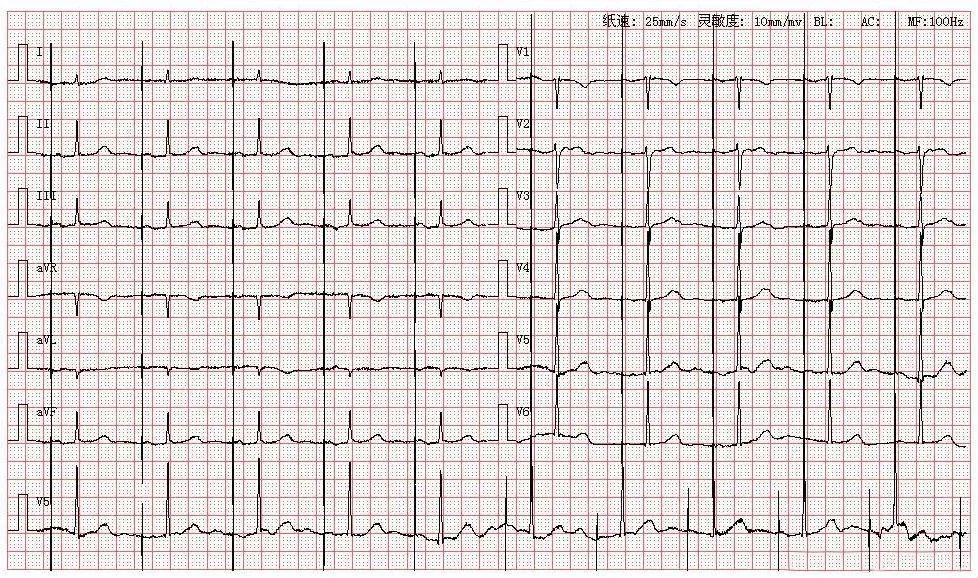 心室起搏心电图特点图片