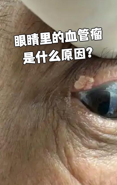 第一,血肿机化会导致血管扩张,形成眼内海绵状血管瘤