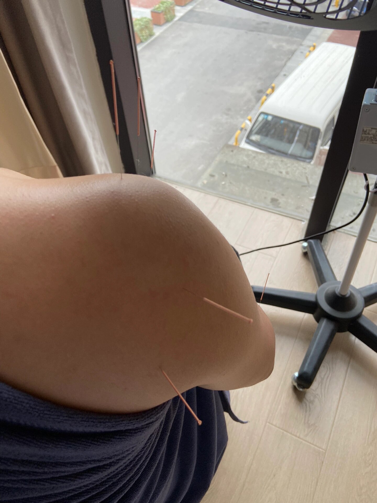 肩膀疼针灸治疗