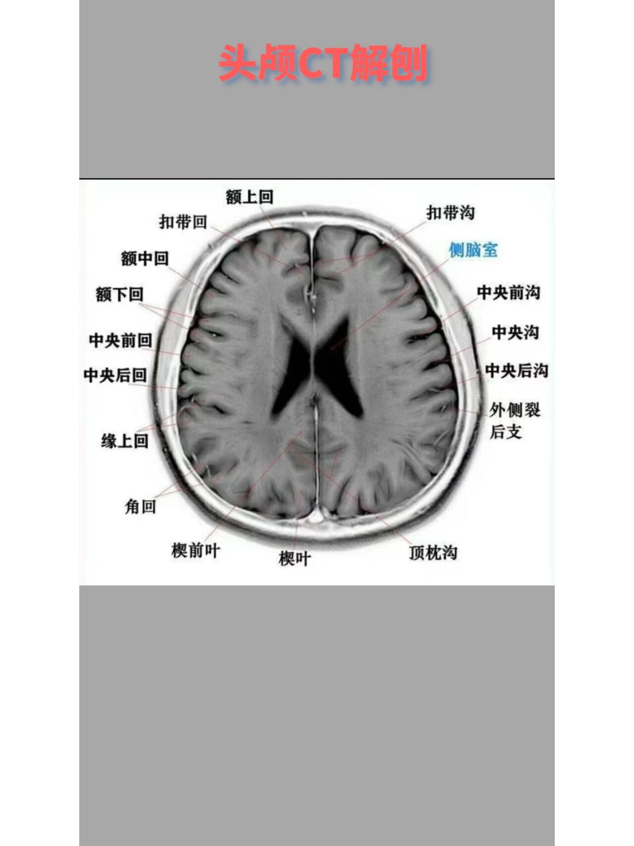 头颅ct解剖