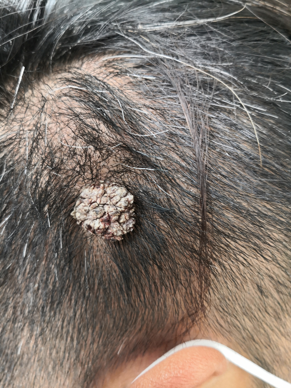 头皮疣状物.可以手术切除活检诊断一下.#寻常疣##皮脂腺痣
