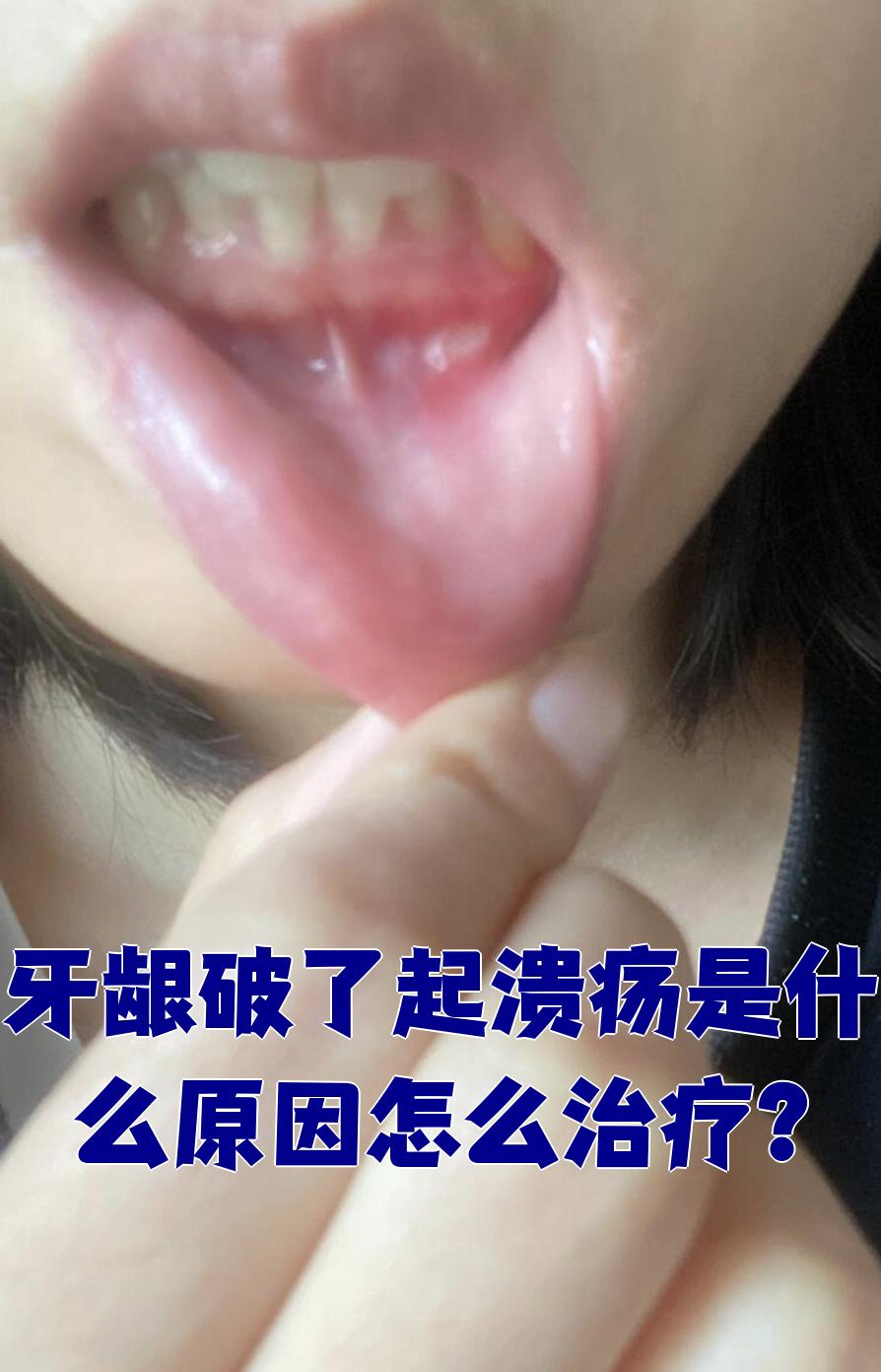 牙龈破溃形成溃疡常见于口腔溃疡,牙龈炎或根尖周炎