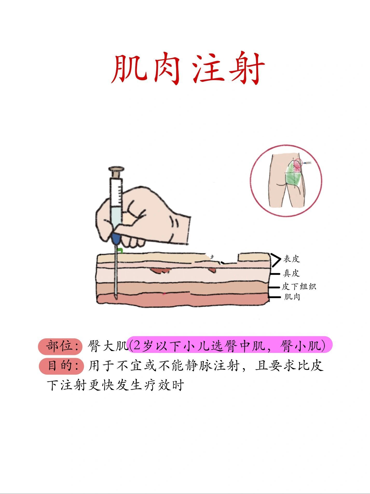 肌肉注射卡通图片图片