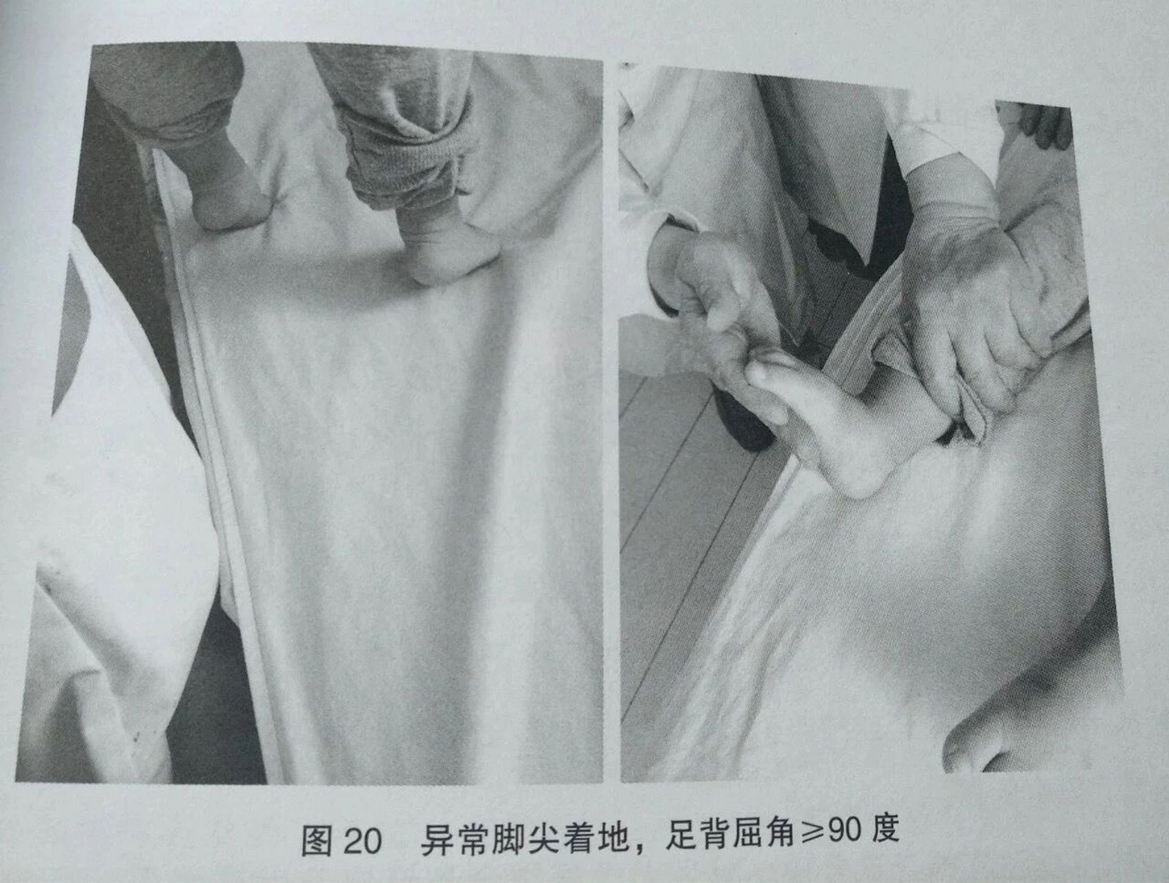 " 孩子出现尖足现象是不是问题呢?会不会影响孩子运动发育?今天就跟