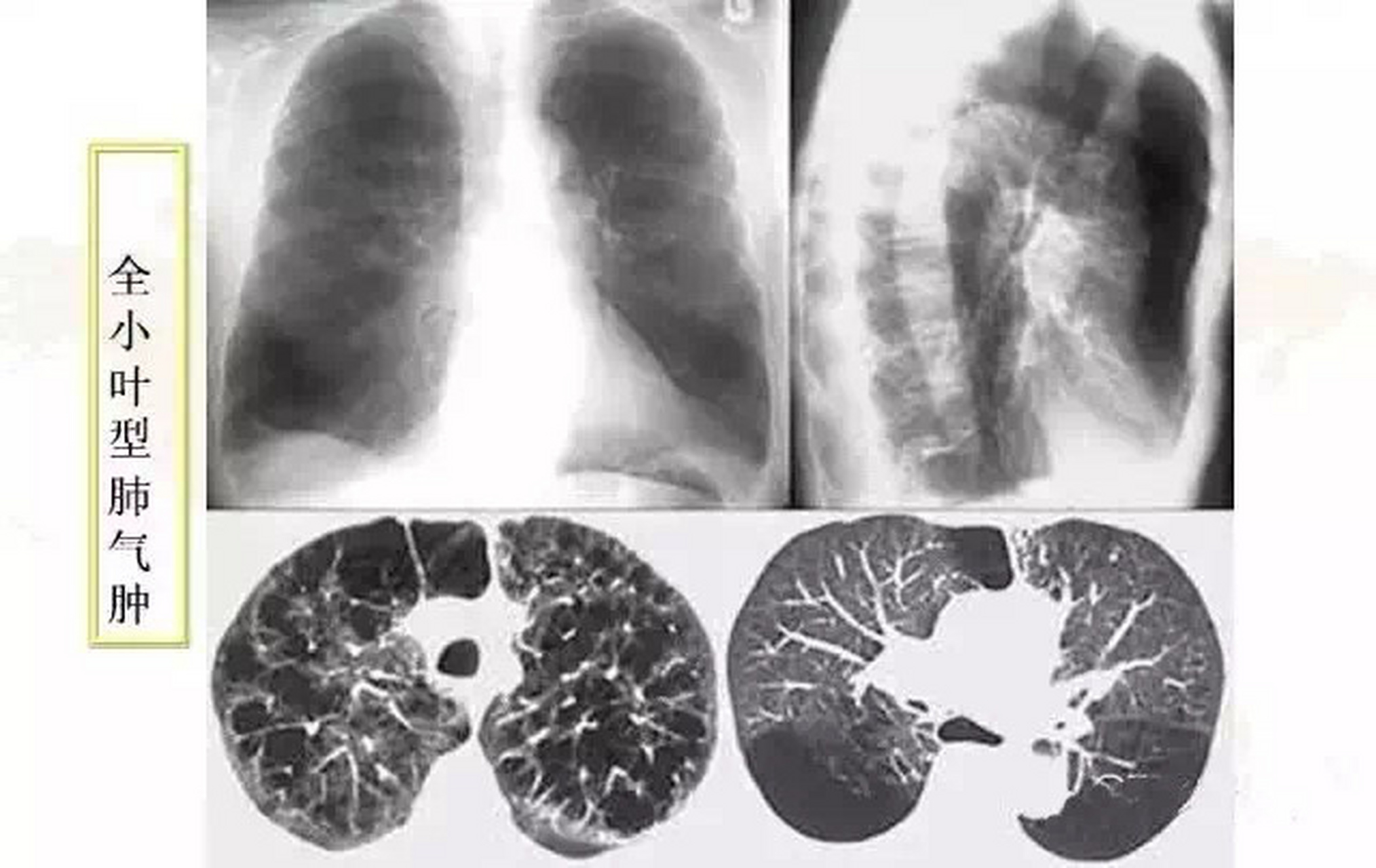 正常的肺和肺气肿图片图片