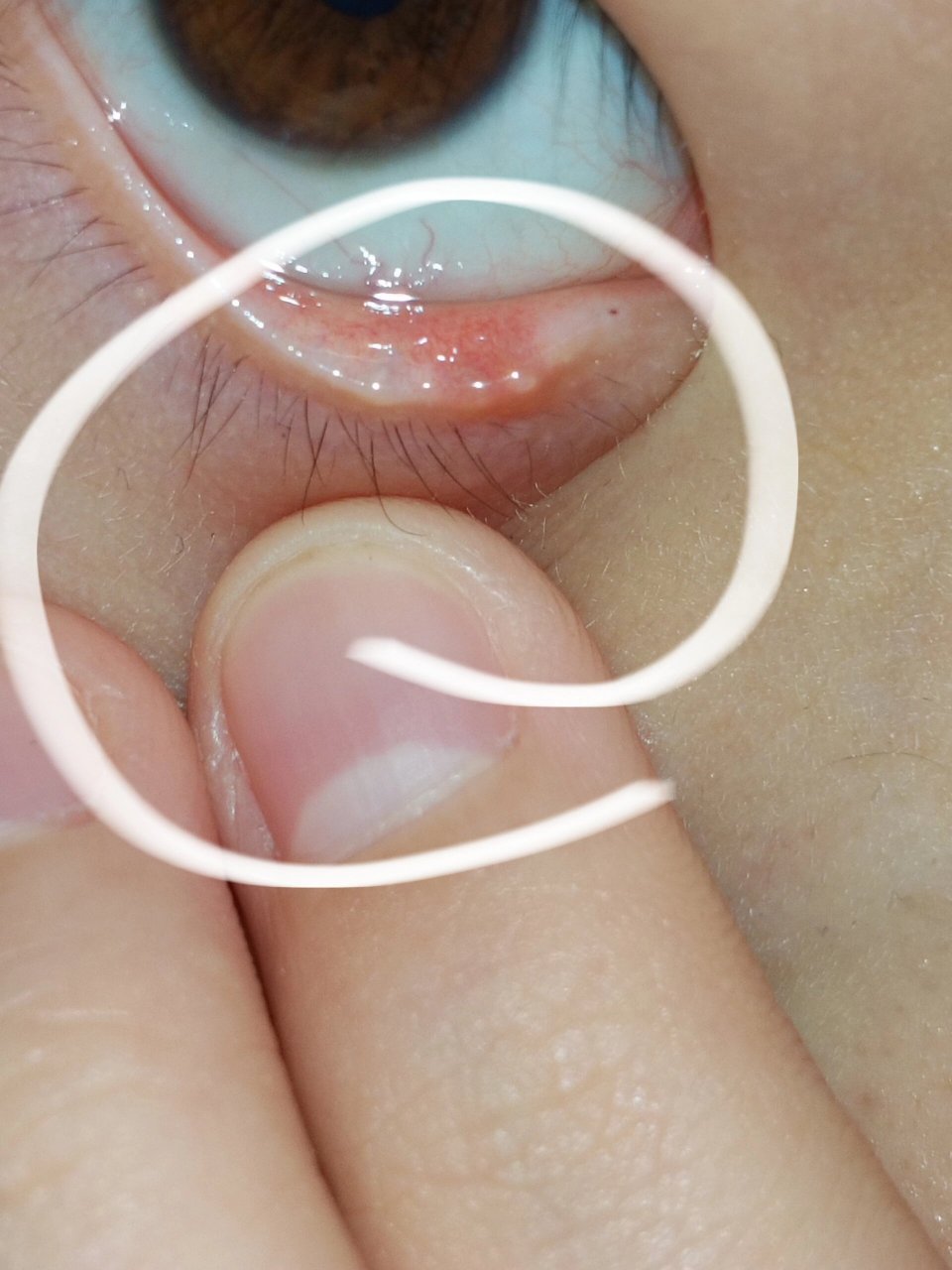 下眼角处长了几个小颗粒有没有事啊?