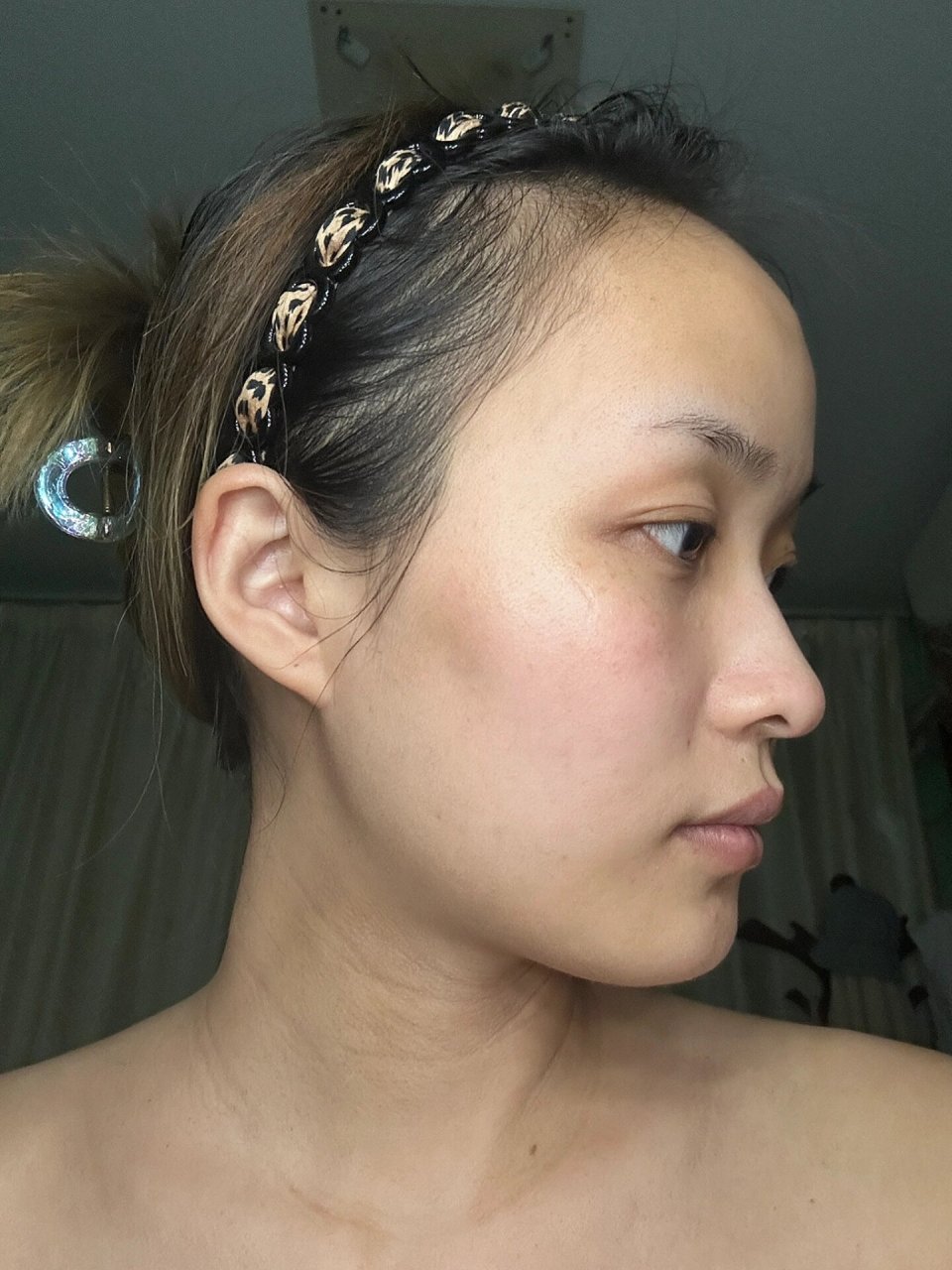 我愿称之为最丑脸型没人反驳吧08 太阳穴凹陷/颧骨突出/面颊凹陷 还