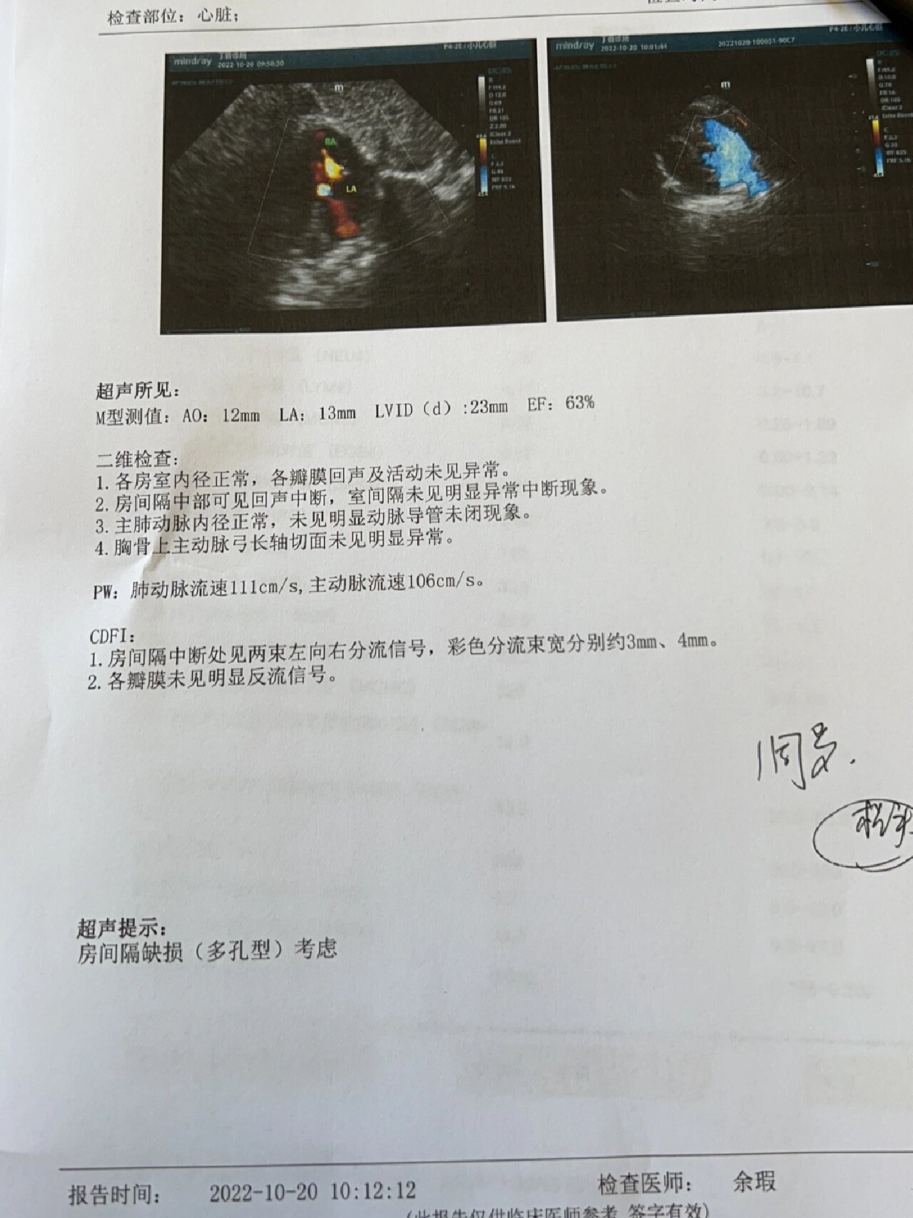 宝宝先心病房间隔缺损2个洞自愈
